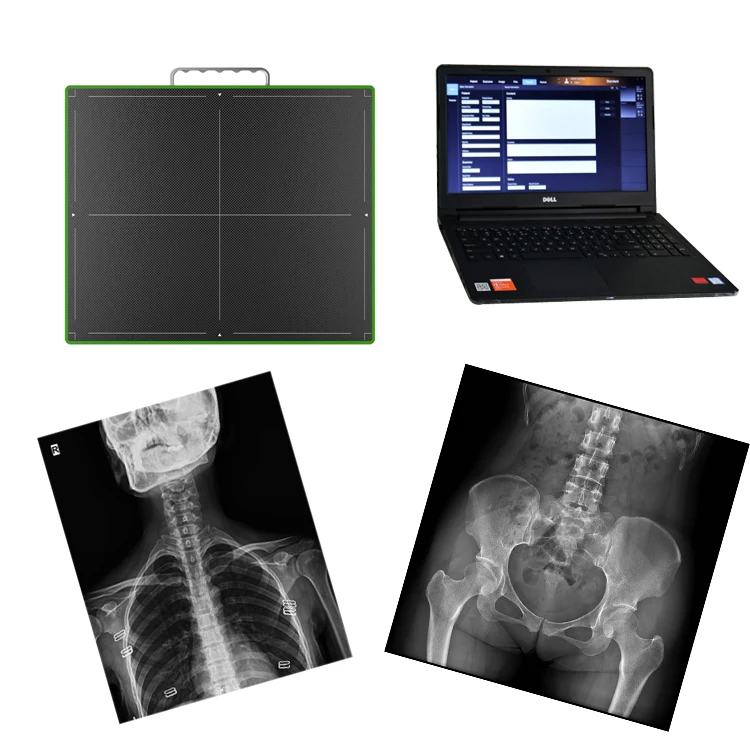 Digital Radiography 17*17 Digital Wireless X-ray Flat Panel Detector For DR System