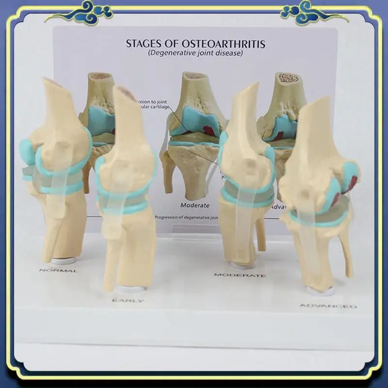Portable Knee Kit Osteoarthritis Anatomy Model With Educational Key Card 4 Stage Knee Model Orthopedic Teaching Aids