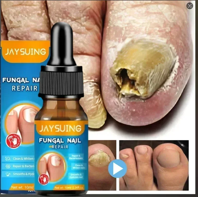 215 Nail Fungals Renewal Nail Repair Liquid for Discolored Thickened Crumbled Nails Nail Fungals for Discolored Broken Cracked 2