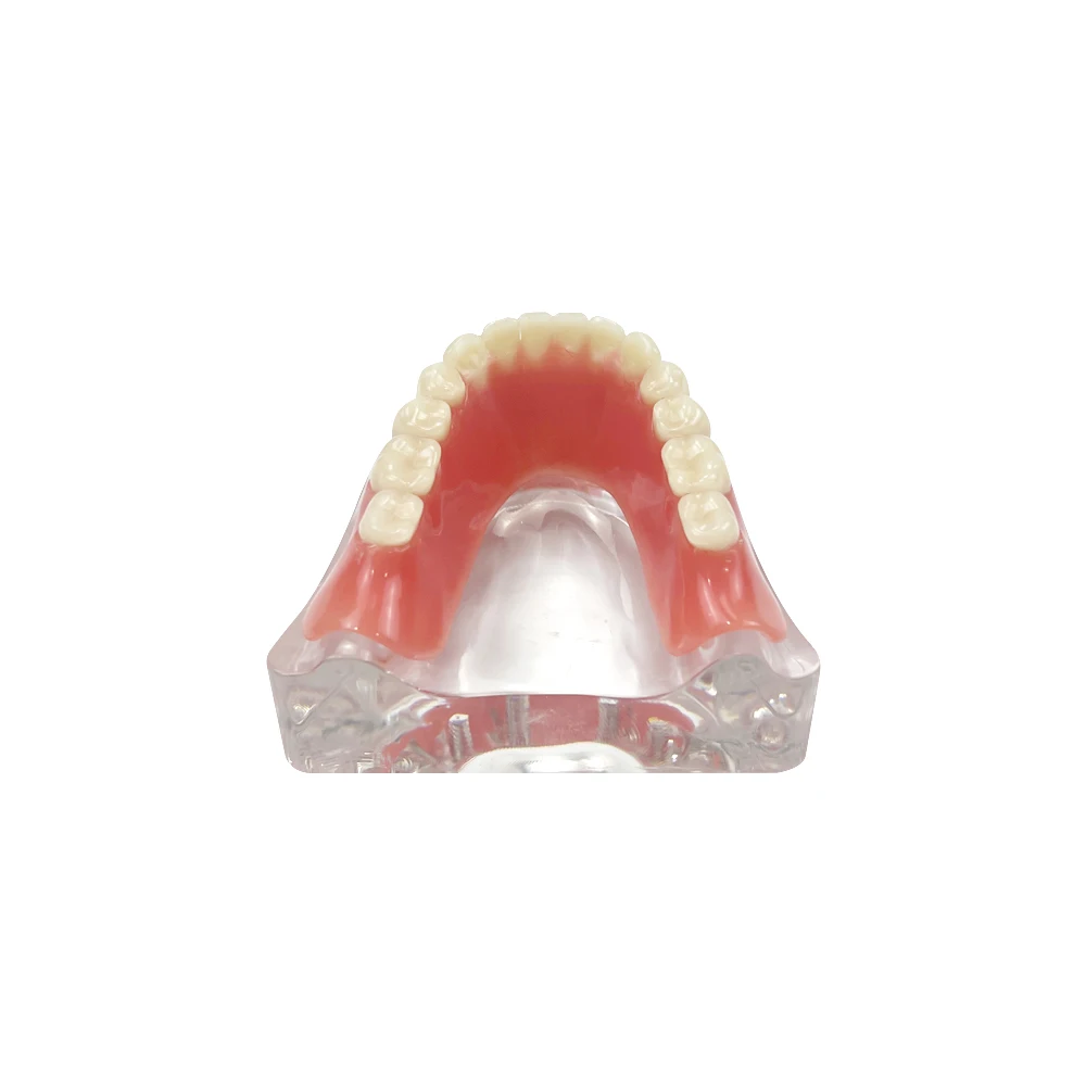 Implant żuchwy Model nauczania zębów dentystycznych Implant Most odbudowy Zdejmowany submaxillary Model na protezę do nauki