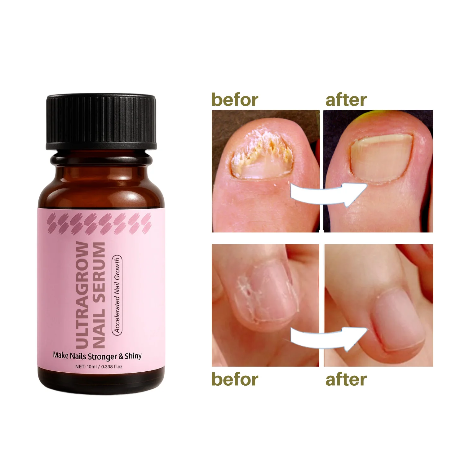 10ML UltraGrow Nail Serum for Growth and Strength with Keratin Complex Olive Oil & Vitamin E for Weak, Brittle, Splitting Nails