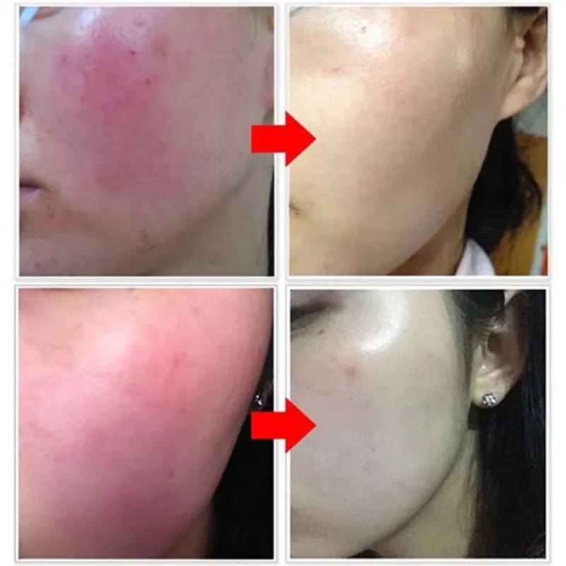 إصلاح احمرار الوجه مصل لحظة العنكبوت الوريد إزالة الجلد الحساسة تهدئة مكافحة احمرار Rosacea علاج غسول مستحضرات التجميل الكورية