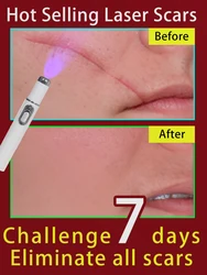 laser scar removal devic