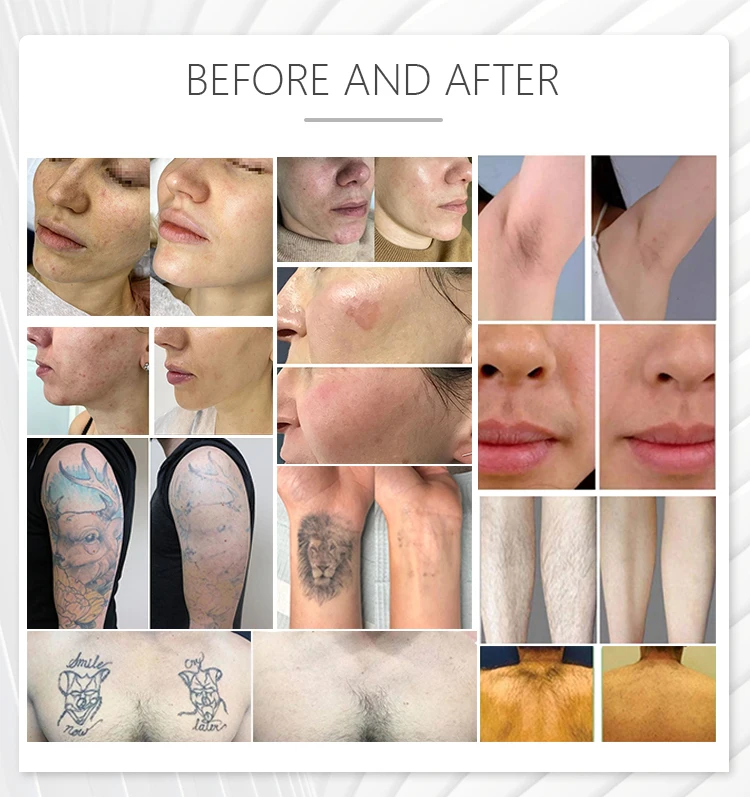 M22 Ipl Dpl Hair Re… - image