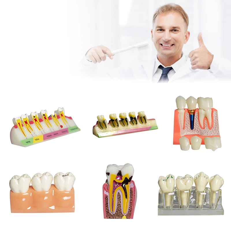 

Dental Implant Teach Crown Bridge Removable Model Porcelain Teeth Model Dental Demonstration Model For Dentist Teaching