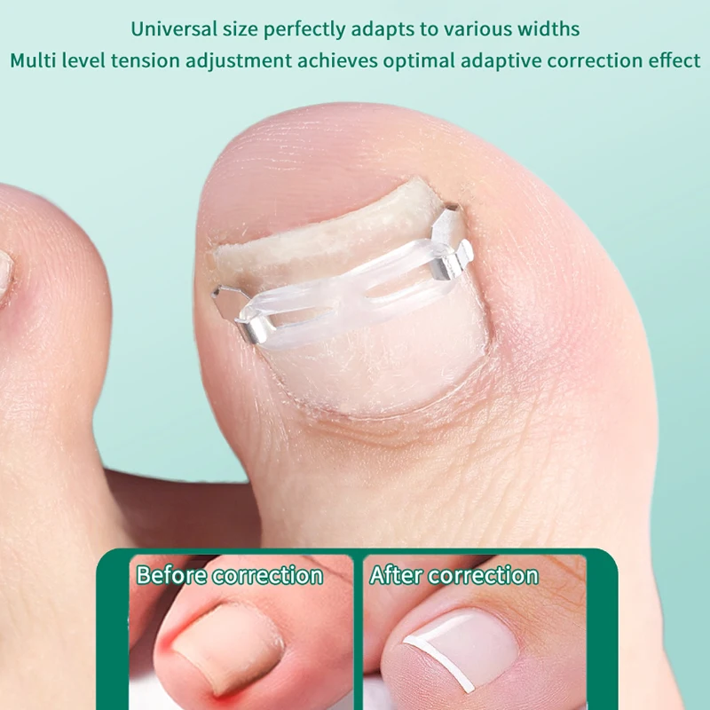 1 Set Ingegroeide Teennagel Corrector Gereedschap Pedicure Herstellen Embedden Teennagel Behandeling Professionele Voetverzorging Correctie Tool