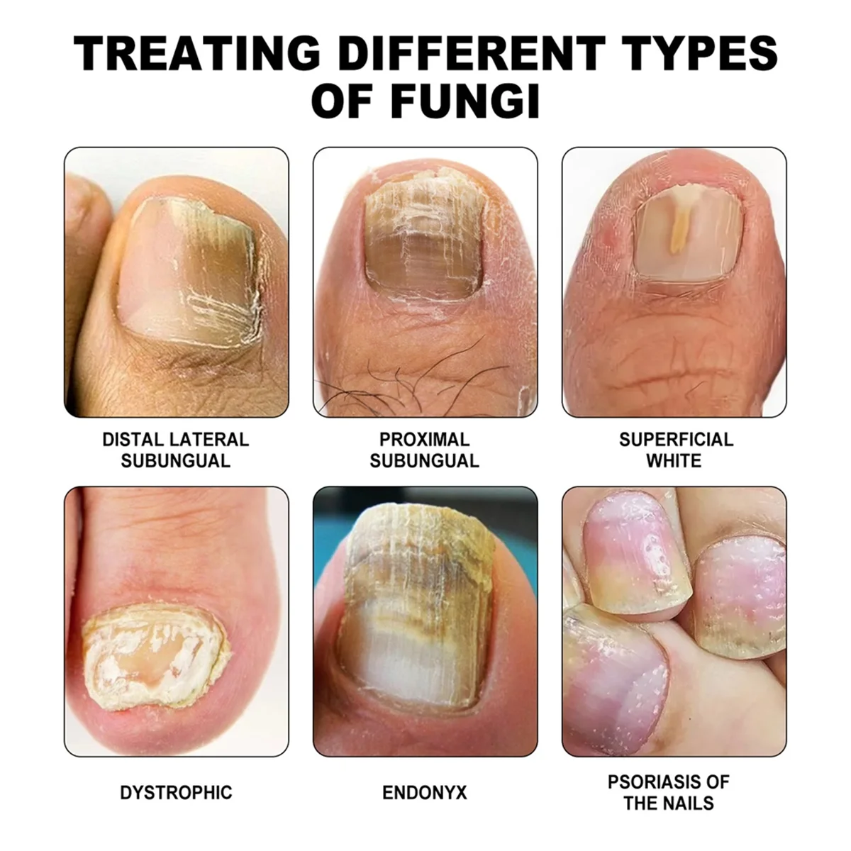 الليزر لجهاز علاج فطريات الأظافر تنظيف فطار الأظافر الفطرية إصلاح القدم الفطريات إزالة الأظافر مكافحة الفطر #3
