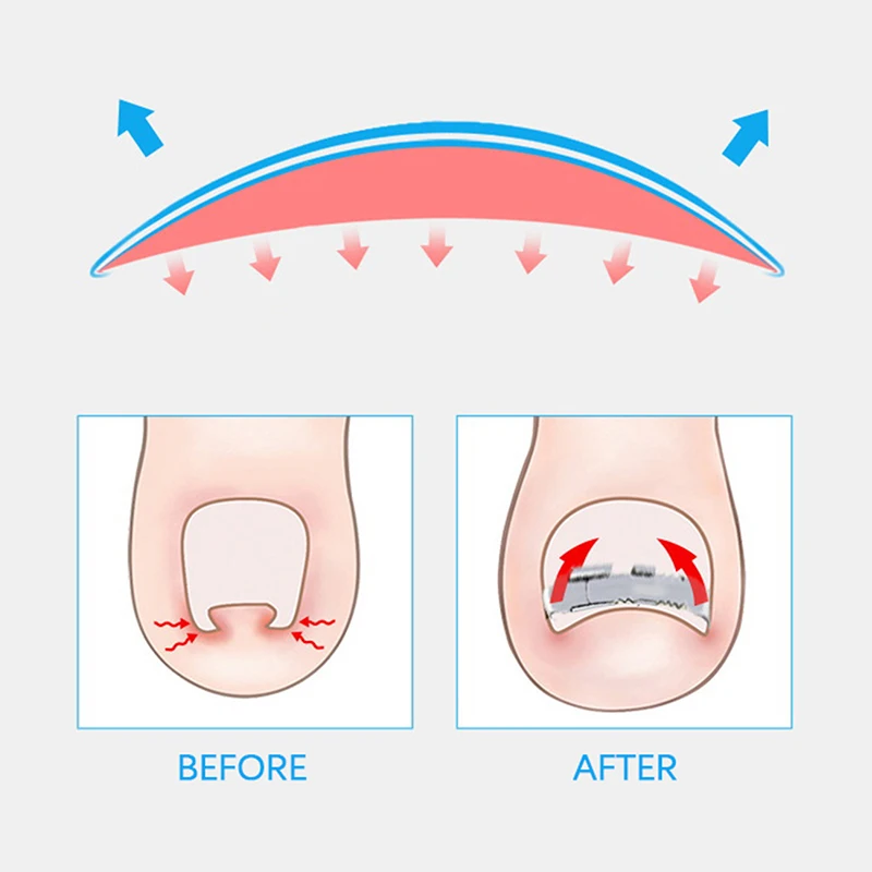 Corrector de uñas encarnadas, herramienta profesional para el cuidado de los pies, pedicura, tratamiento de uñas encarnadas