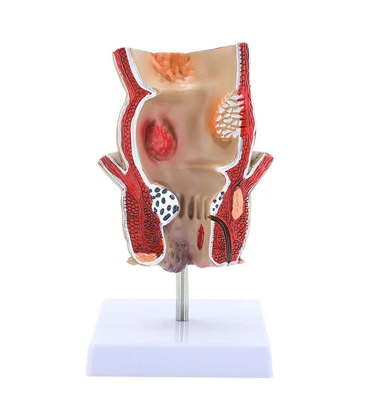 Rectal hemorrhoidal lesion model Hemorrhoidal internal and external anatomy Anorectal anorectal pathological model