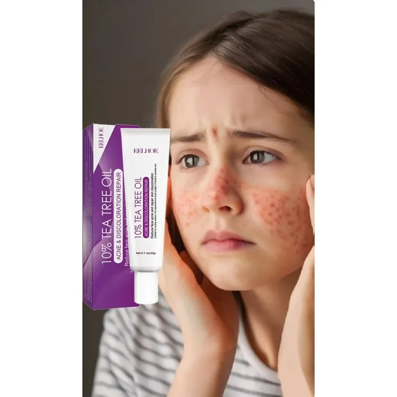 

Tea Tree Acne Treatment Cream Pore Shrink Oil Control Whitening Repair Pimple Deep Cleaning Anti-acne Moisturizer Face Skin Care