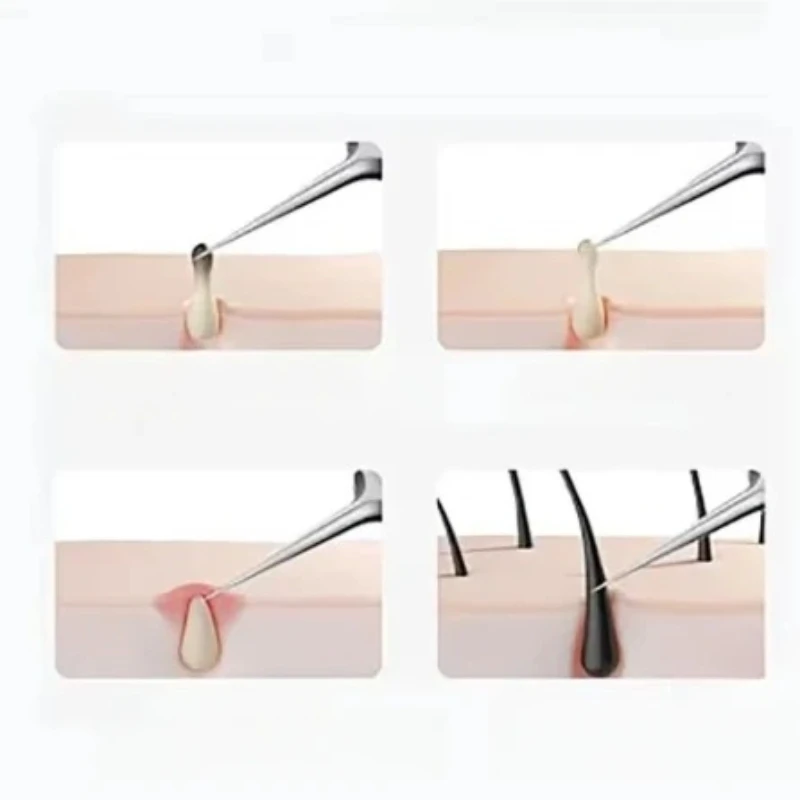 Edelstahl Pinzette für eingewachsene Haare, Akne-Mitesser-Entfernung, Nadeln, schwarze Punkte, Reiniger, Poren, Tiefenreinigung, Gesichtspflege-Werkzeuge