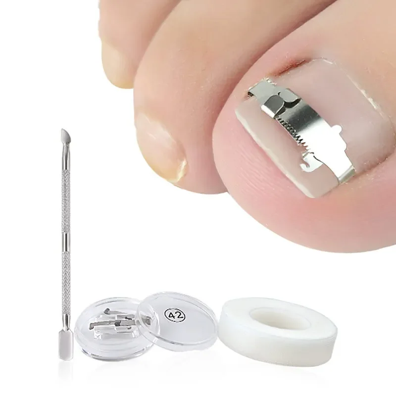 1 ensemble correcteur d'ongle incarné fixateur d'ongle orthopédique traitement de Correction d'ongle outils de soins des pieds outil de récupération intégré