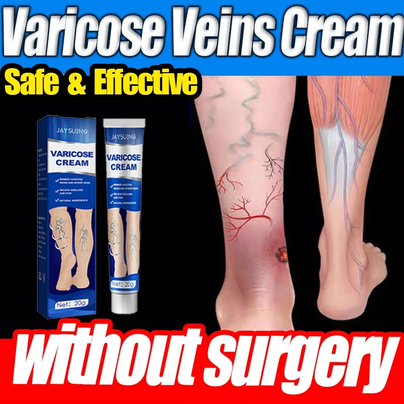 Varicose Vein Repair Cream Effective Relieves Leg Bulge Pain Treatment Ointment Vasculitis Phlebitis Remove Vein Plaster