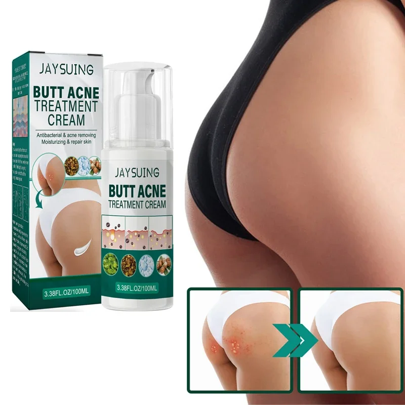 

Hip Acne Cream Mild Repair Acne Removing Cream Nourishing Lightening Refreshing and Nourishing Skin