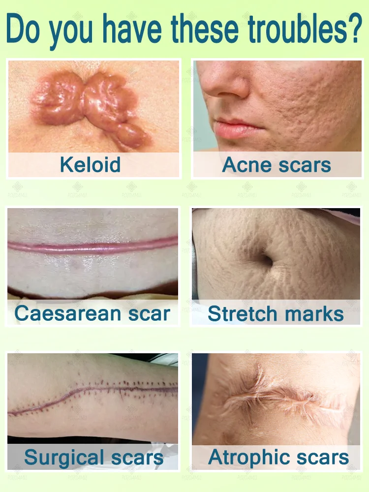 Crema para eliminar cicatrices