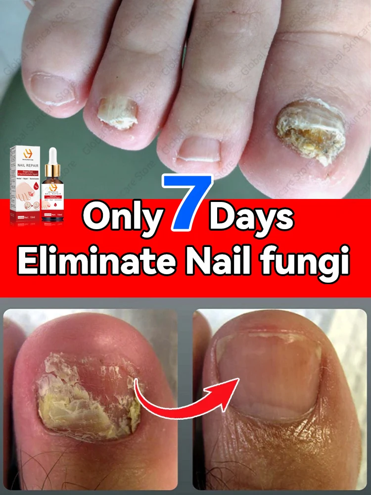 Nail fungi Problem product