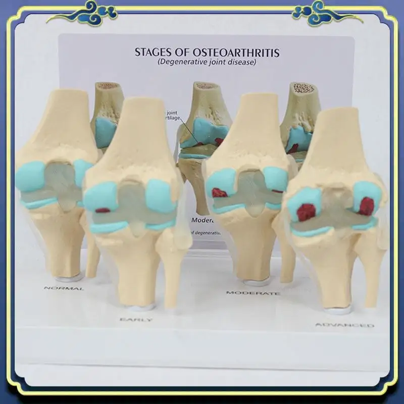 Portable Knee Kit Osteoarthritis Anatomy Model With Educational Key Card 4 Stage Knee Model Orthopedic Teaching Aids