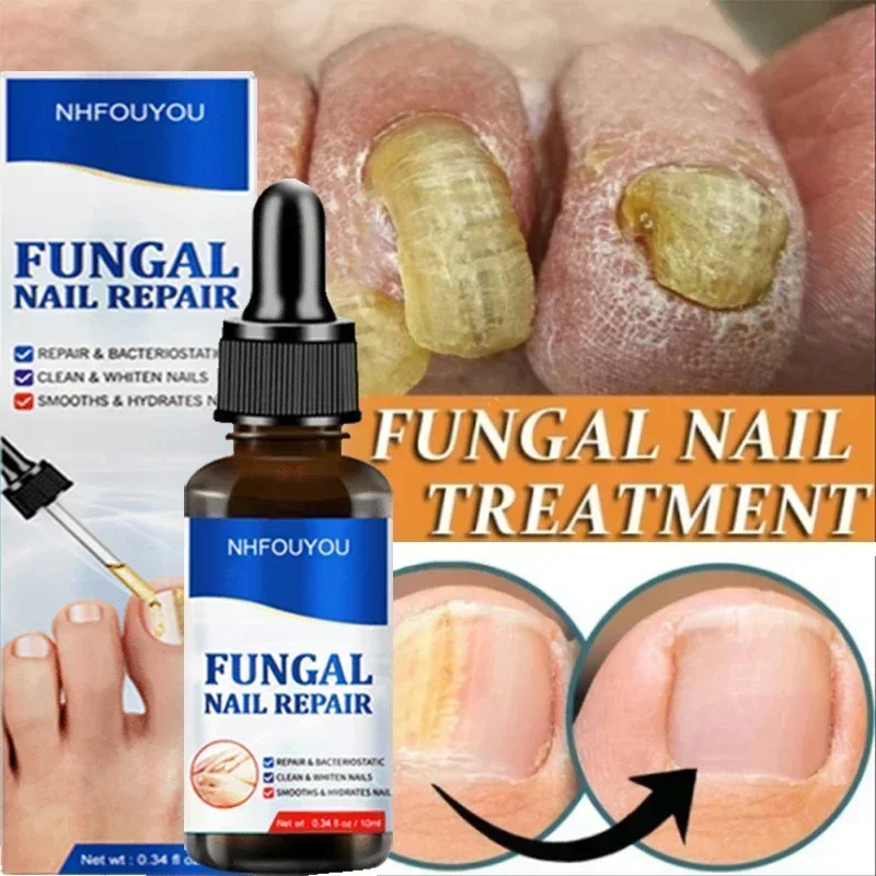 Suero para tratamiento de hongos en las uñas, productos de reparación de hongos en los dedos, Gel de eliminación para el cuidado de los pies y las manos, antiinfección, paroniquia, onicomicosis