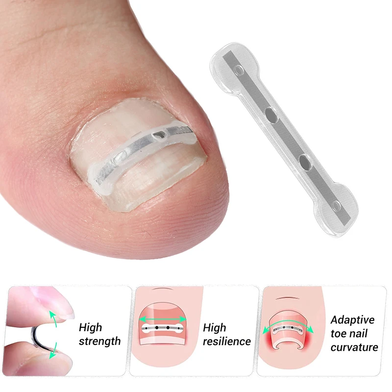 Ingrown Toenail Correction Tool Ingrown Toe Nail Treatment Elastic Patch Sticker Straightening Clip Brace Pedicure Tool