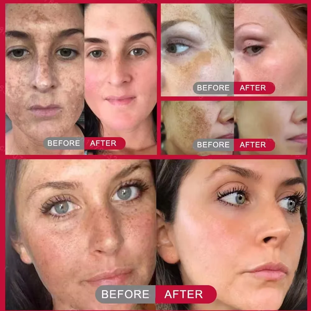 Effective Whitening Freckles Face Cream Removal Melasma Dark Spots Fade Melanin Pigmentation Corrector Brighten Repair Skin Care