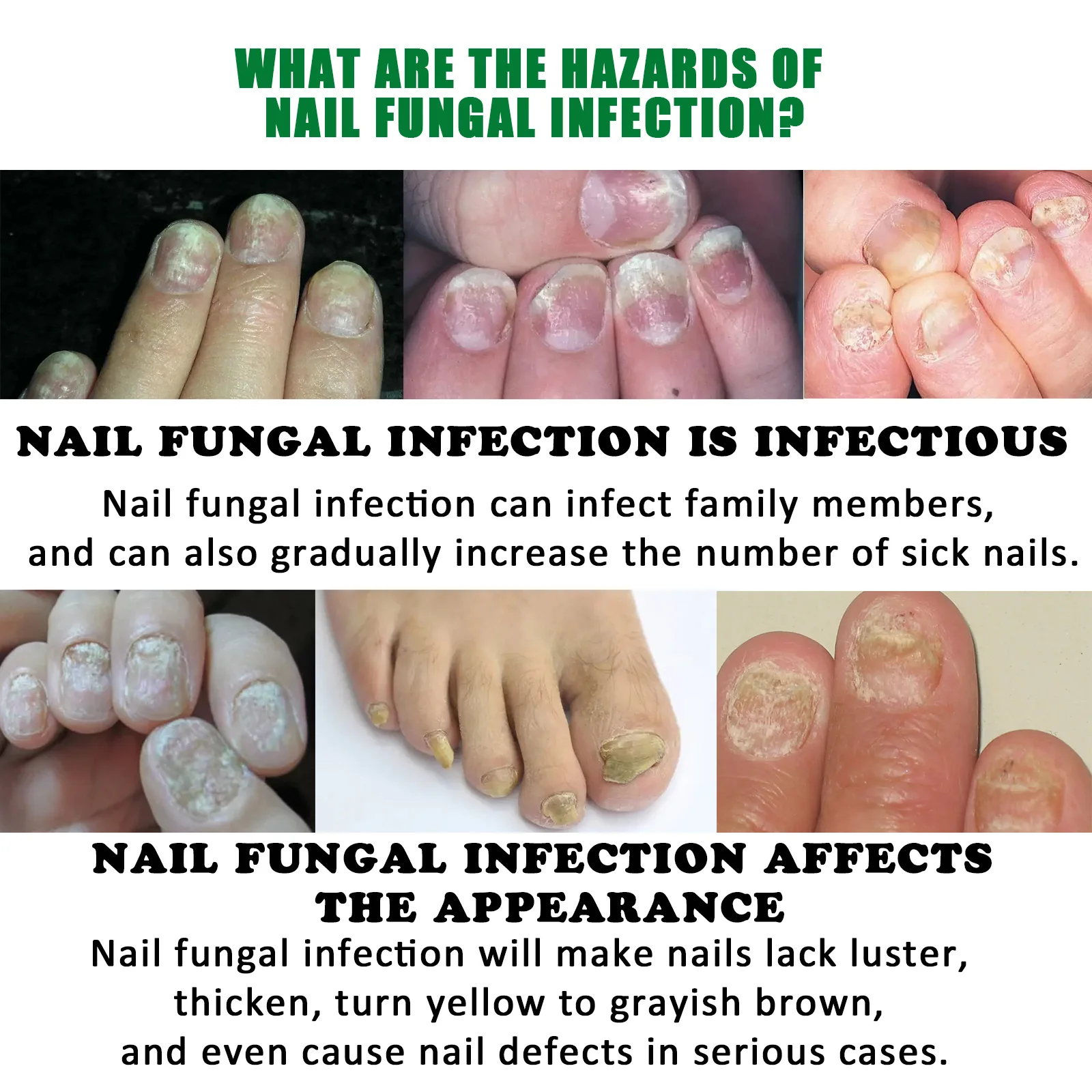 Nail Fungus Treatment Serum Care Hand and Foot Care Removal Repair Gel Anti-infective Onychomycosis Ginger Nail Care Solution