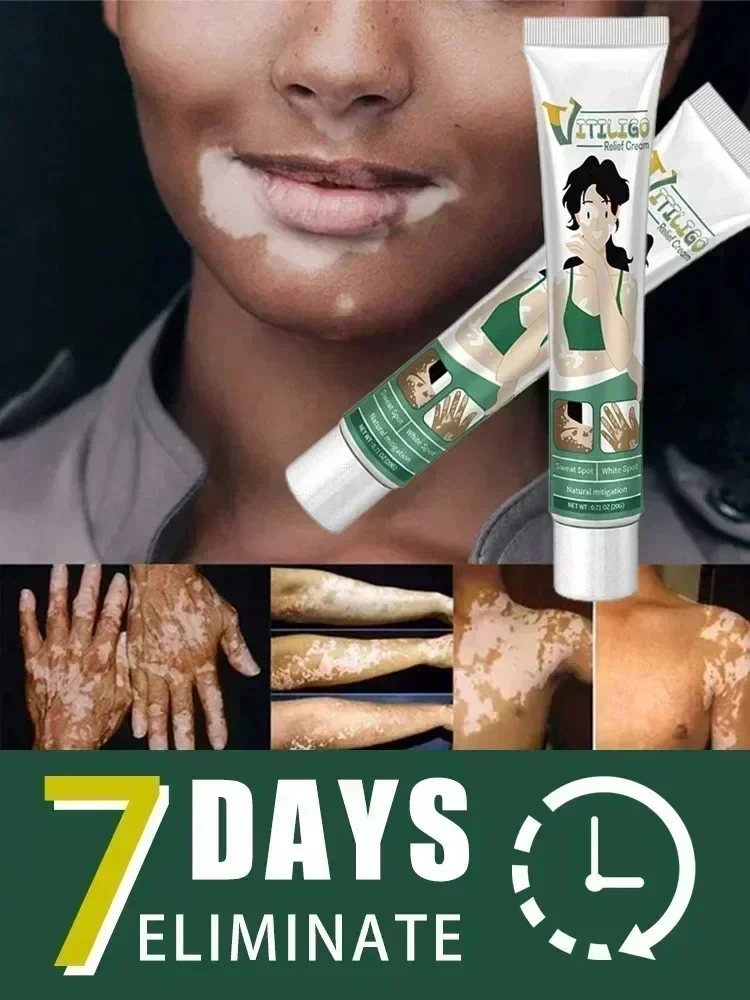 Vitiligo Cream Remove Ringworm White Spot Removal Skin Vitiligo Eliminate Vitiligo Cream Body Skin Care