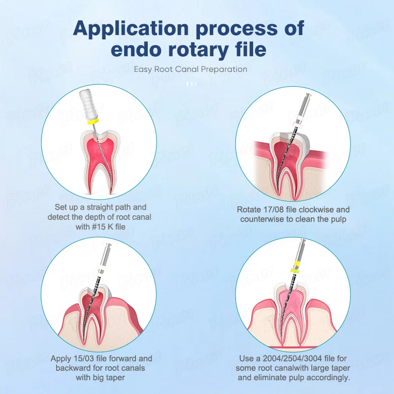 فينر 5 قطعة ملفات اللبية للأسنان ملفات قناة الجذر إندو المنشط بالحرارة ملفات دوارة اللبية 25/21 مللي متر أداة طبيب الأسنان طب الأسنان