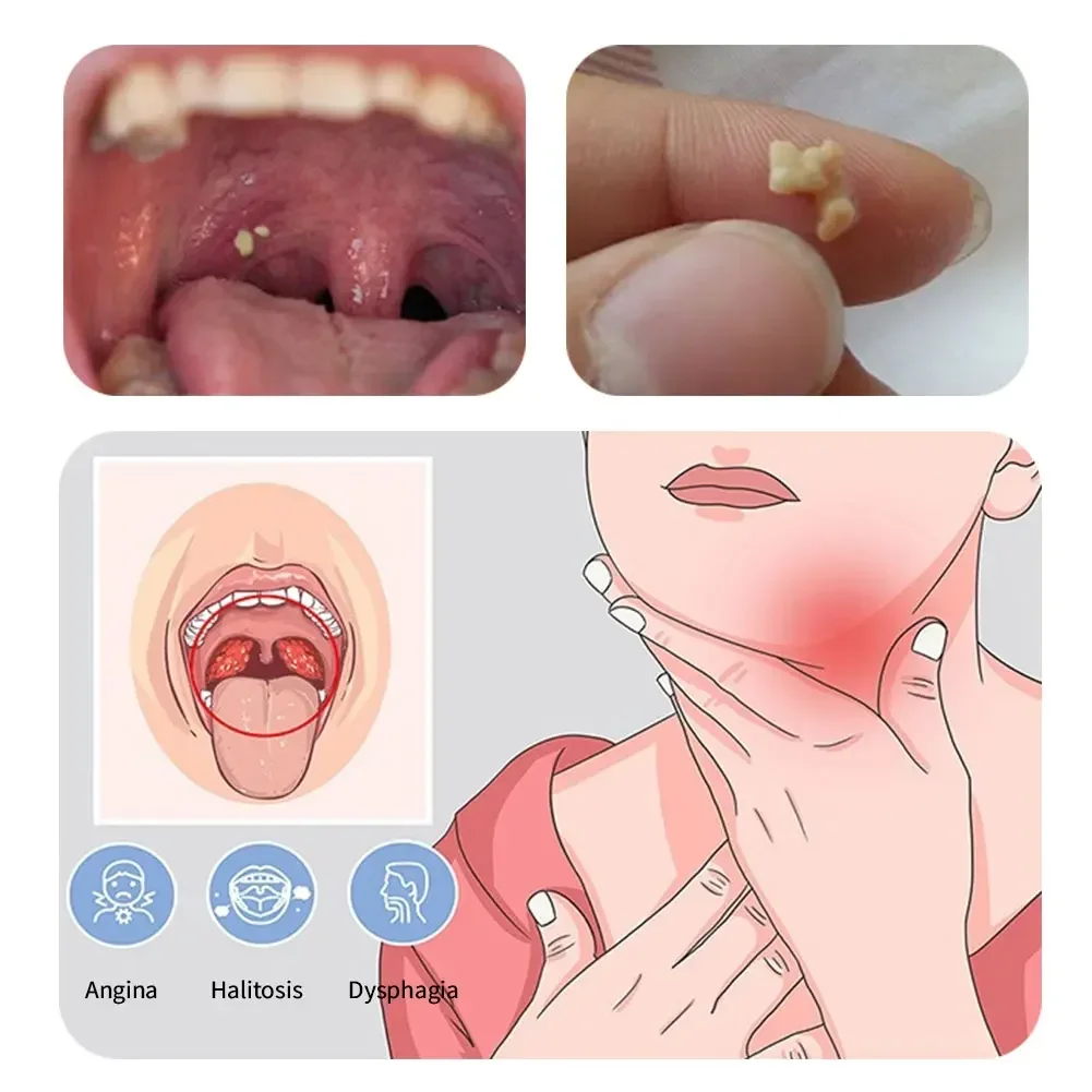 مصباح ليد الفولاذ المقاوم للصدأ مزيل الفم تنظيف أدوات العناية مزيل حجر اللوزات 1 قطعة الأذن الشمع أداة إزالة حجر اللوزيت