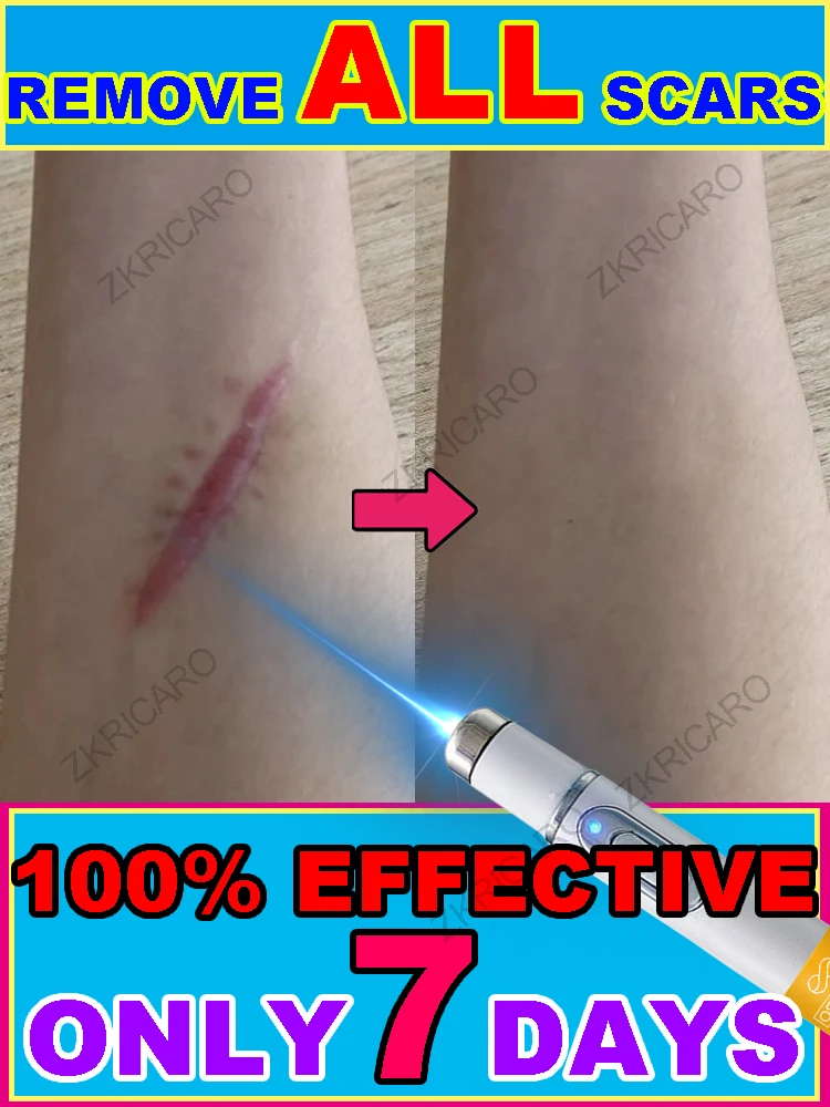 Dispositif laser de qualité médicale, économisez votre peau!