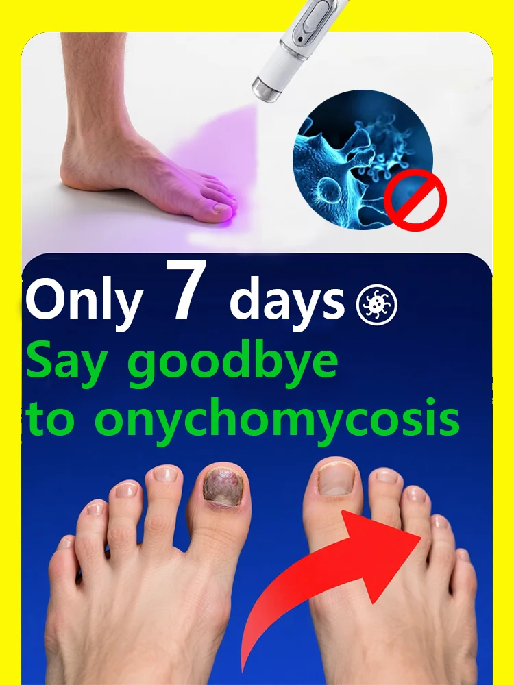 

Профессиональное лазерное устройство для лечения грибка ногтей — для ногтей на ногах и руках, ремонт обесцвеченных/ поврежденных ногтей, безопасное домашнее использование