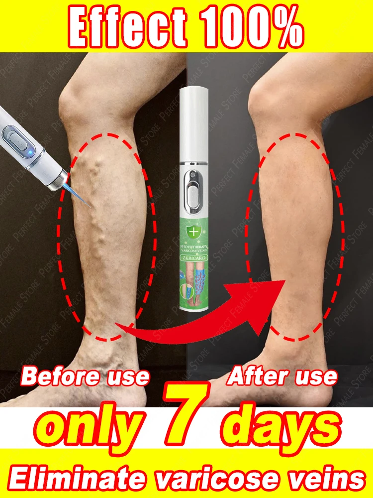 

Varicose Veins Products