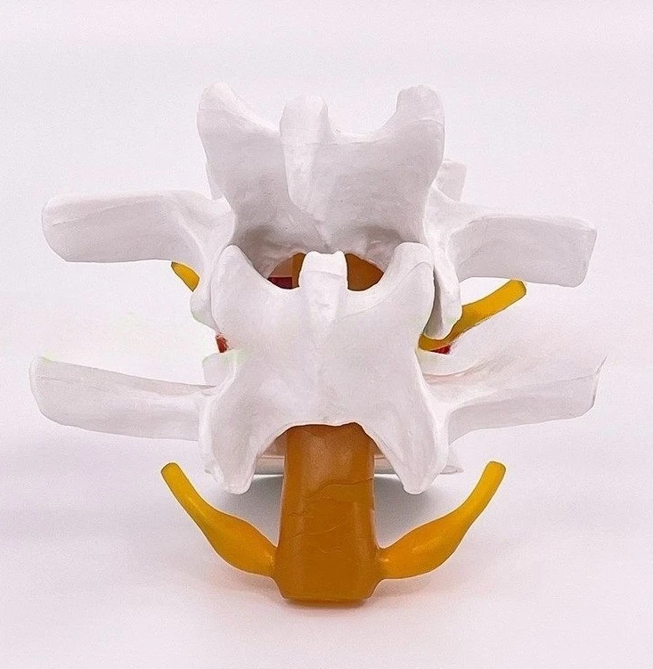 

Lumbar Expansion, Lumbar Intervertebral Disc Model, Squeeze Herniation Demonstration Model
