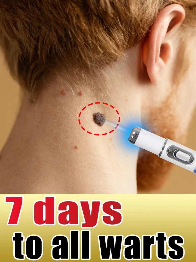 

Быстро удаляет бородавки, безболезненные лазерные инструменты горячей продажи