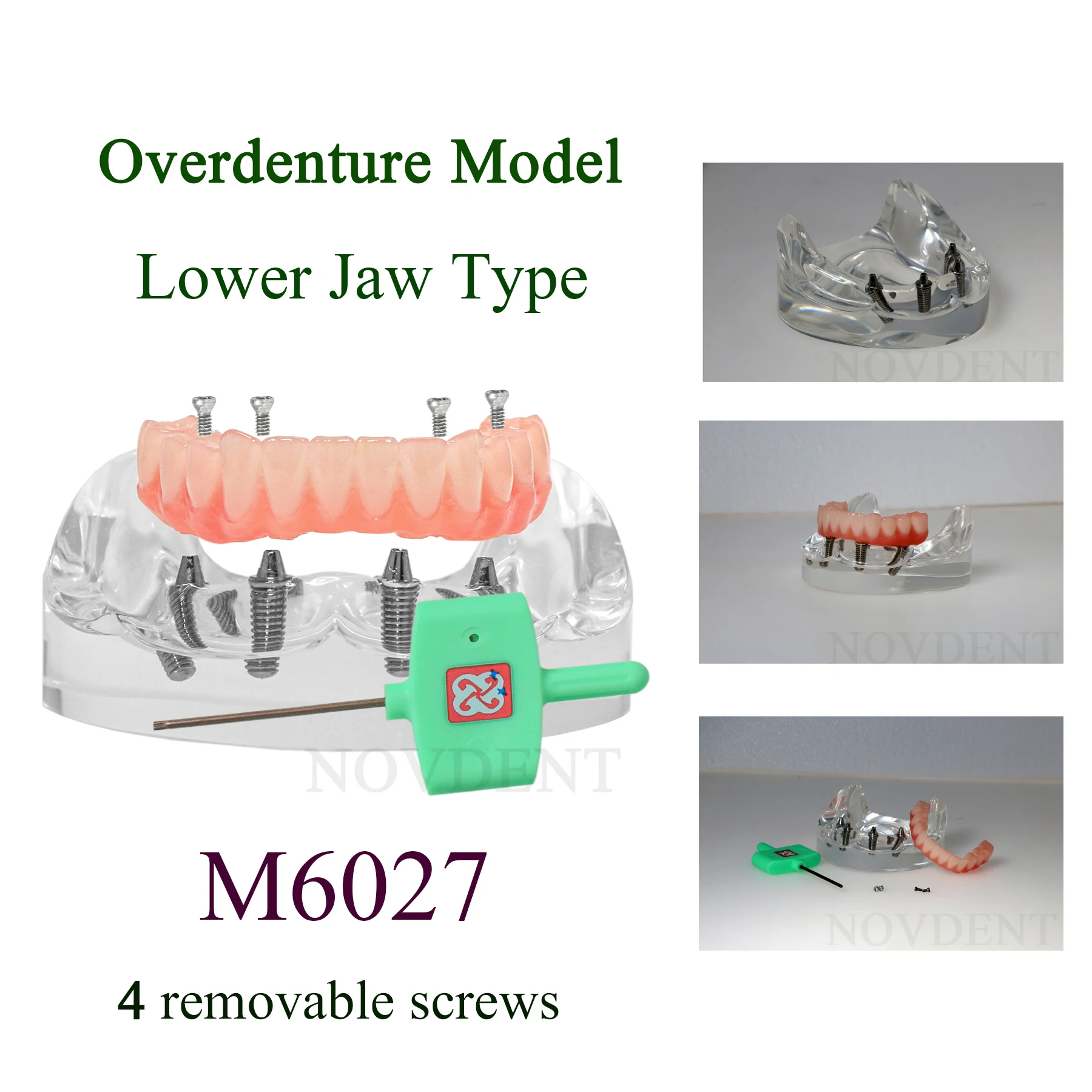 Dental Implant Models Transparent Upper/Lower Jaw Overdenture Restoration Removable Teeth Model Dentisit Teaching Demo Model