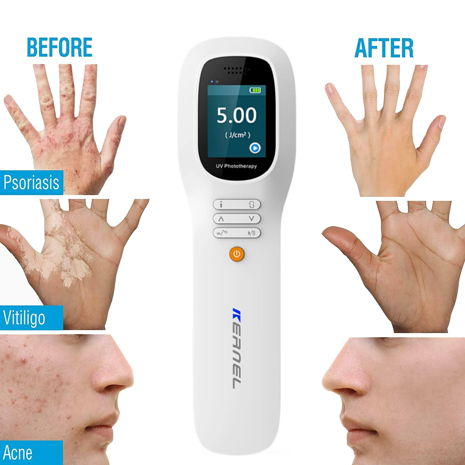 Kernel KN-5000H Handheld Portable LED 308nm Excimer Laser Machine for Targeted Treatment of Psoriasis Vitiligo Atopic Dermatitis