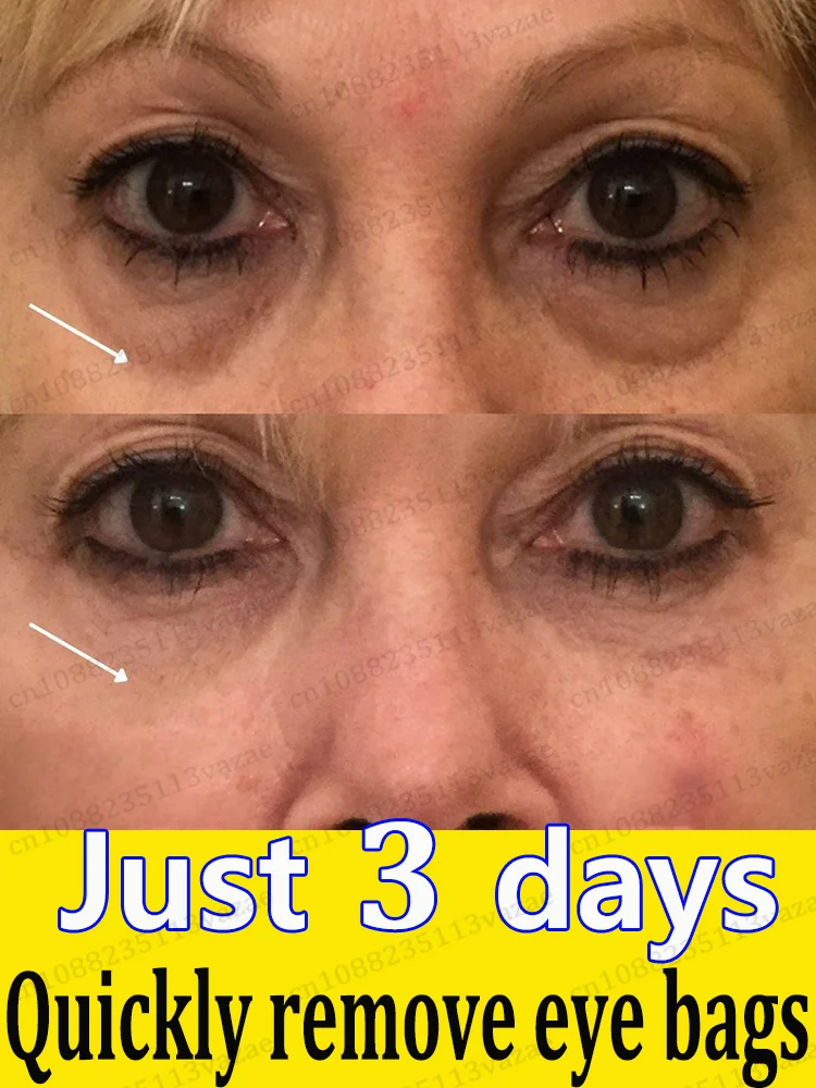 

Eʟɪᴍɪɴᴀᴛᴇ ᴇʏᴇ ʙᴀɢs, ᴅᴀʀᴋ ᴄɪʀᴄʟᴇs, ᴀɴᴅ ᴡʀɪɴᴋʟᴇs