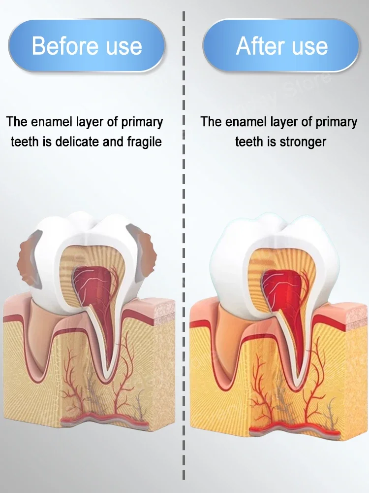 Caries disappear