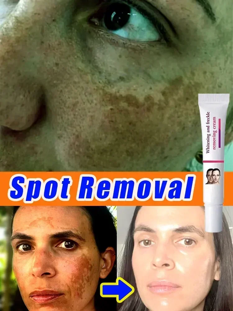 Freckles Removal Cream Remove Facial Spots Skin Dark Spot Remove Melasma Age Spots Sunspots Whitening And Freckle Removing Cream