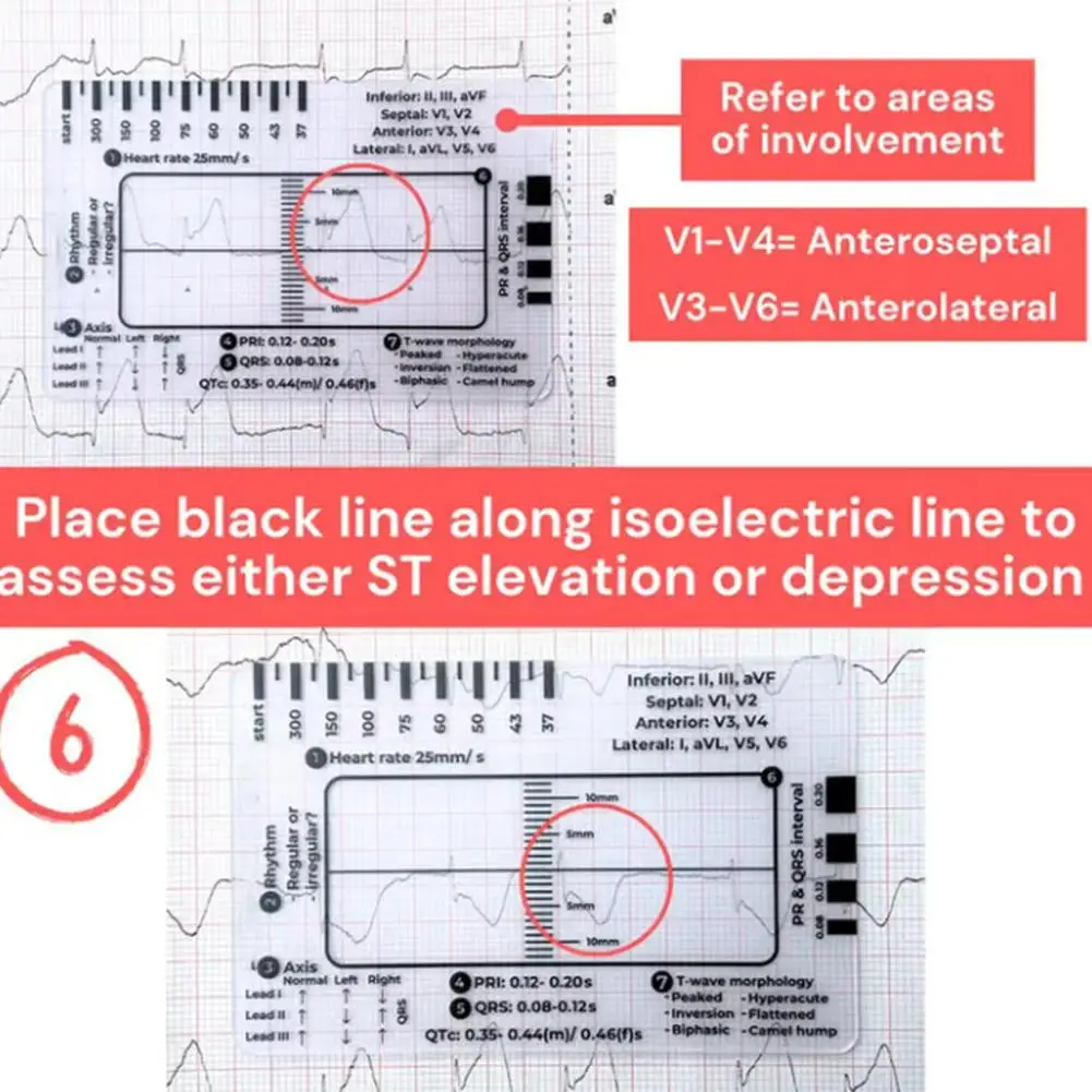 Ecg 7 passo régua portátil batimento cardíaco ecg observação transparente 7 passos escala ferramenta de medição régua para interpretação ecg