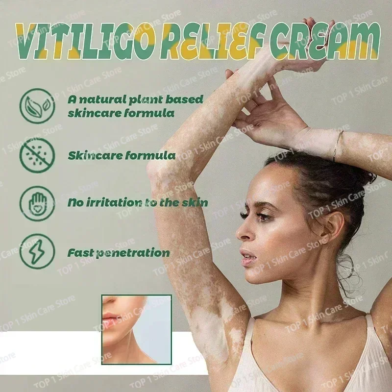 NewEffective vitiligo repair cream and white spot lightening product