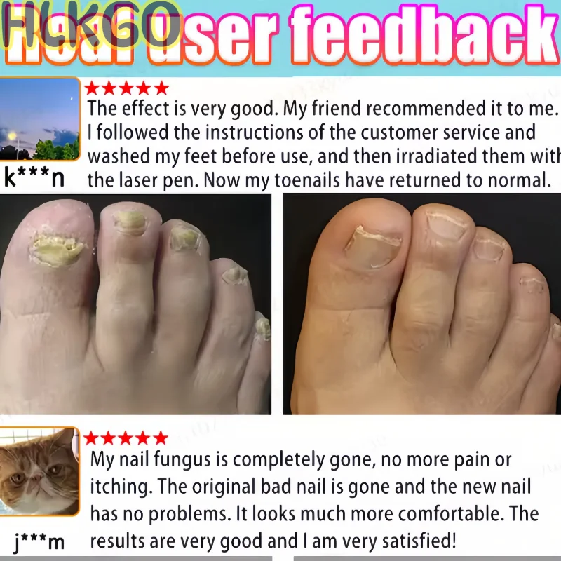 

Скажи прощайте на онихомикоз, без вторжения, без повреждения ногтей.