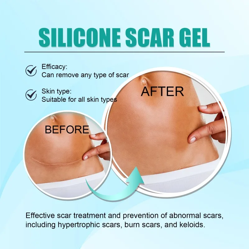 Silicone Scar Gel Remove Burn Surgical Scar Stretch Mark Repair Pigmentation Corrector Gel Smooth Beauty Painless Skin Care