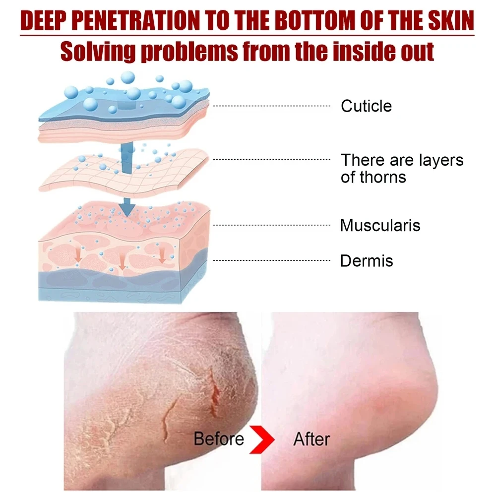 قناع تقشير القدم ، قناع تقشير ، إصلاح الكعب ، يزيل الجلد الميت الجاف ، القدمين المتشققة الجافة