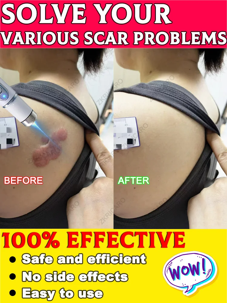 Quiero deshacerse de cicatrices, probar esto