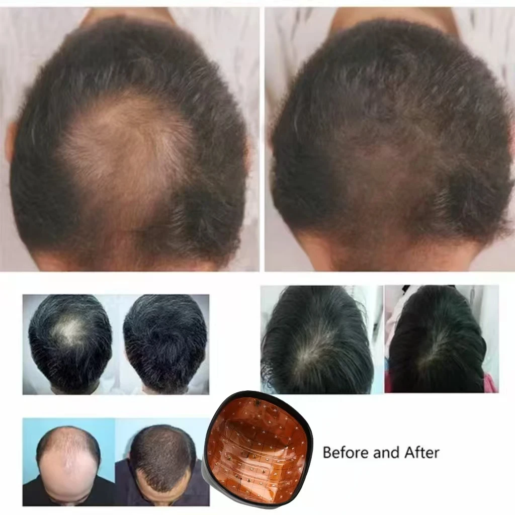 Anti Hair Loss and Hair Growth Cap 92 Laser and LED 650nm Red Infrared Light Therapy Scalp Treatment for Thinning Hair Men Women