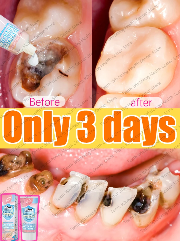 Repair tooth decay artifact and restore dental health