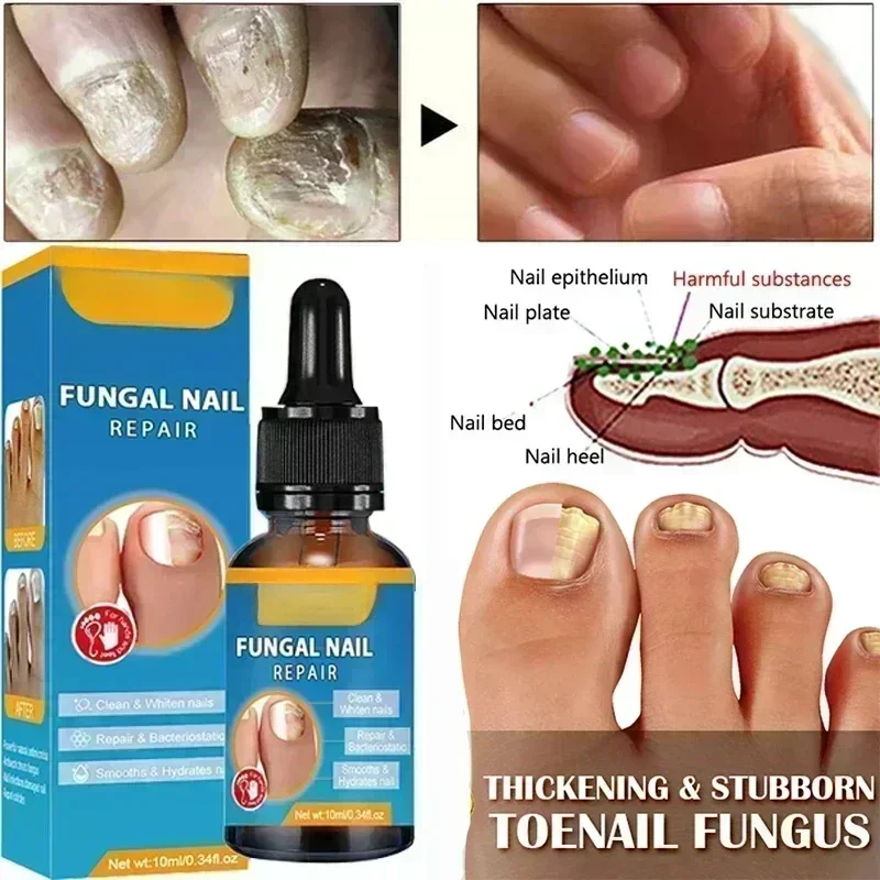 เชื้อราเล็บ Treatment Serum Toe Fungal Repair ผลิตภัณฑ์มือเท้า Care เจลกําจัด Anti Infection Paronychia Onychomycosis