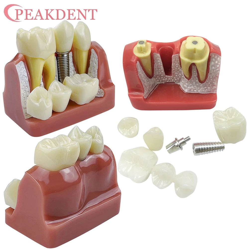 Dental 4 Times Implant Teeth model Dentisty Study Training Teaching Model Analysis Crown Bridge Demonstration Removable Model