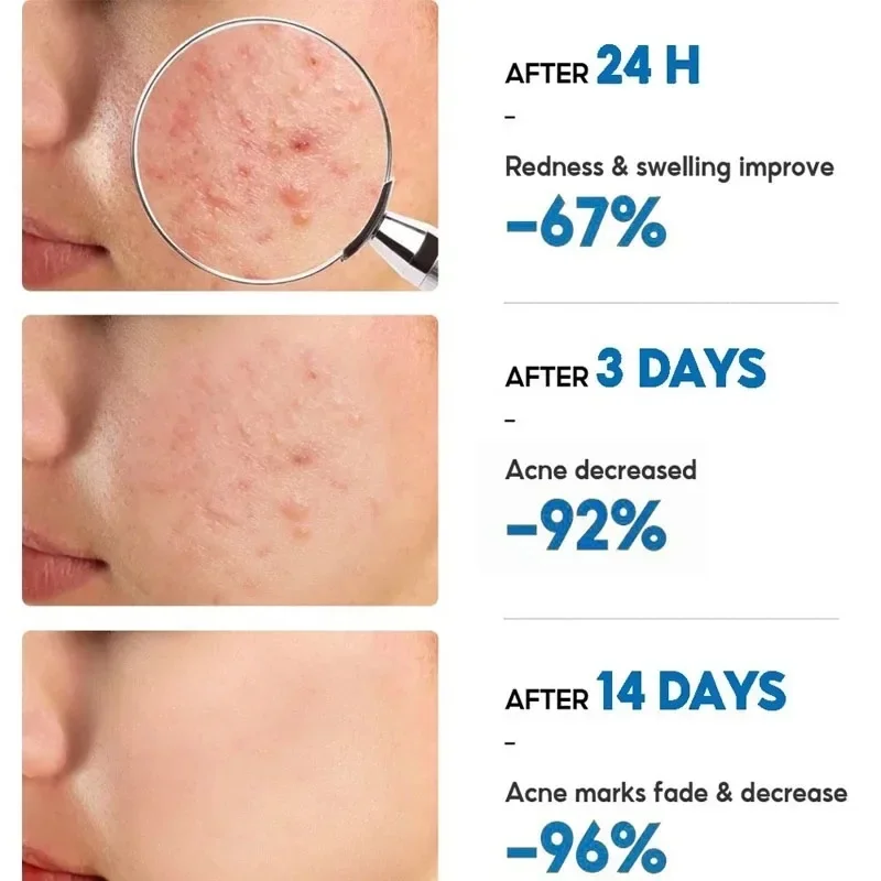 Salicylic Acid Acne Removal Cream Anti-Acne Repair Redness Pimple Spots Deep Cleaning Pore Oil Control Moisturizing Skin Care image 3