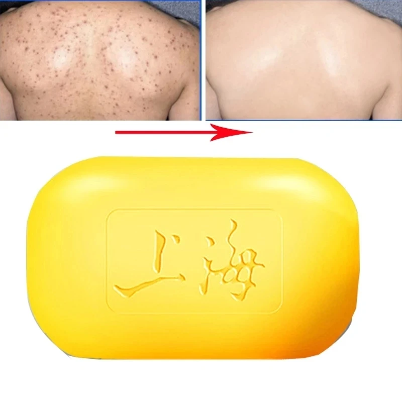 6PCS Shanghai Sulfur Soap Oil-Control Acne Treatment Psoriasis Seborrhea Eczema Anti Fungus Perfume Butter Bubble Bath 85g